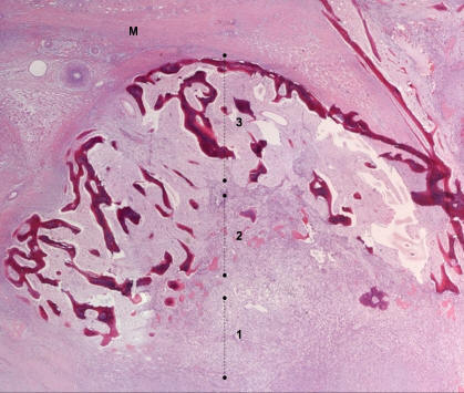 Myositis Ossificans Circumscripta Without History of Trauma 