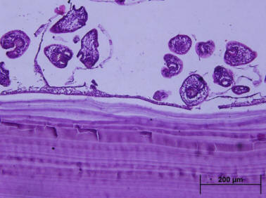 Primary Hydatid Cyst: An Unusual Cause of a Mass | Iynen | Journal of ...