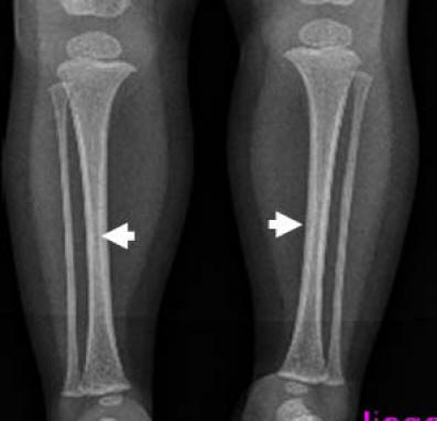 Mid-diaphyseal Endosteal Thickening With Subsequent Medullary Narrowing ...