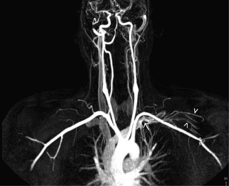 Subclavian Vein Thrombosis Extending into the Internal Jugular Vein ...