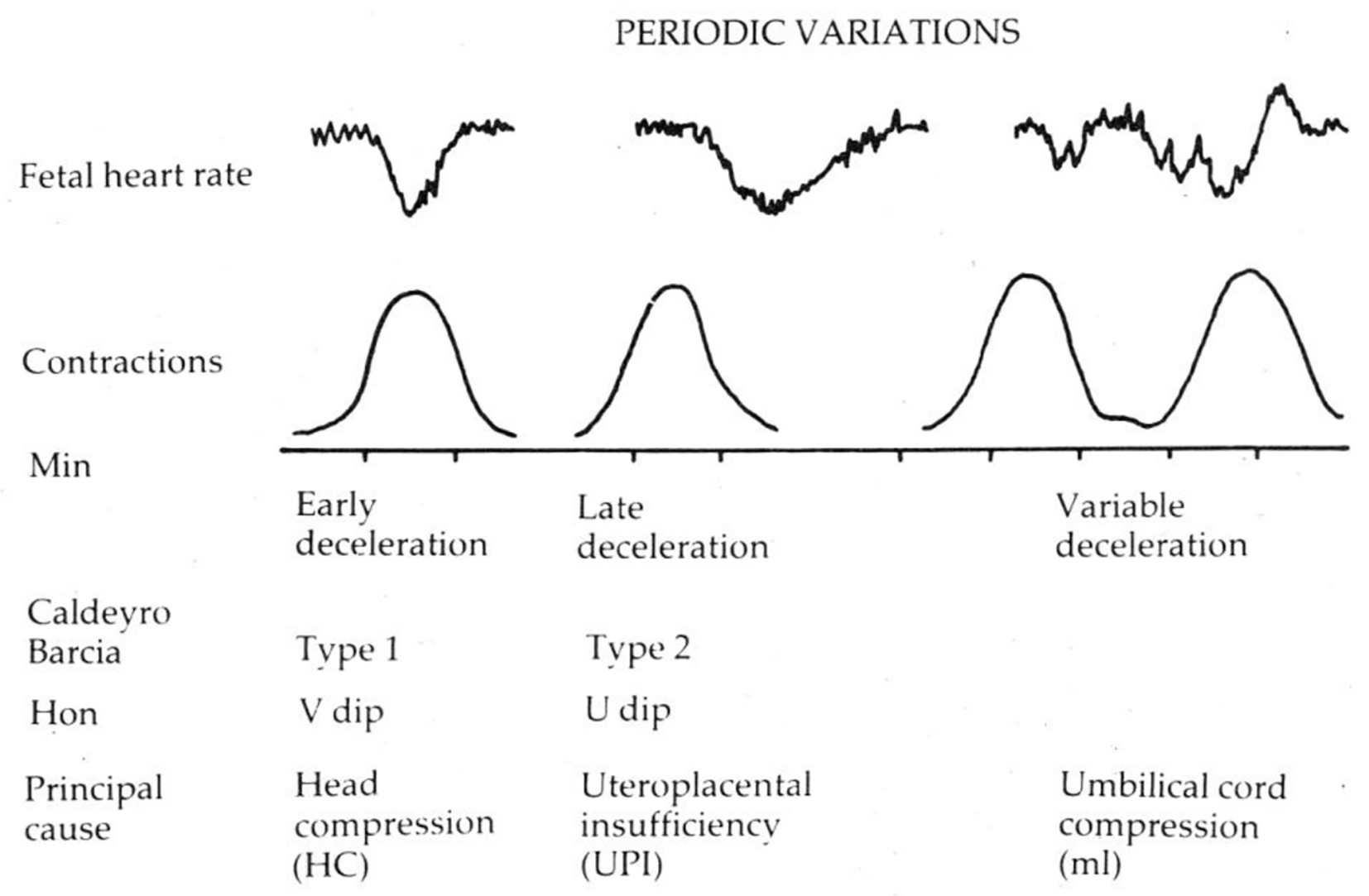 Deceleration