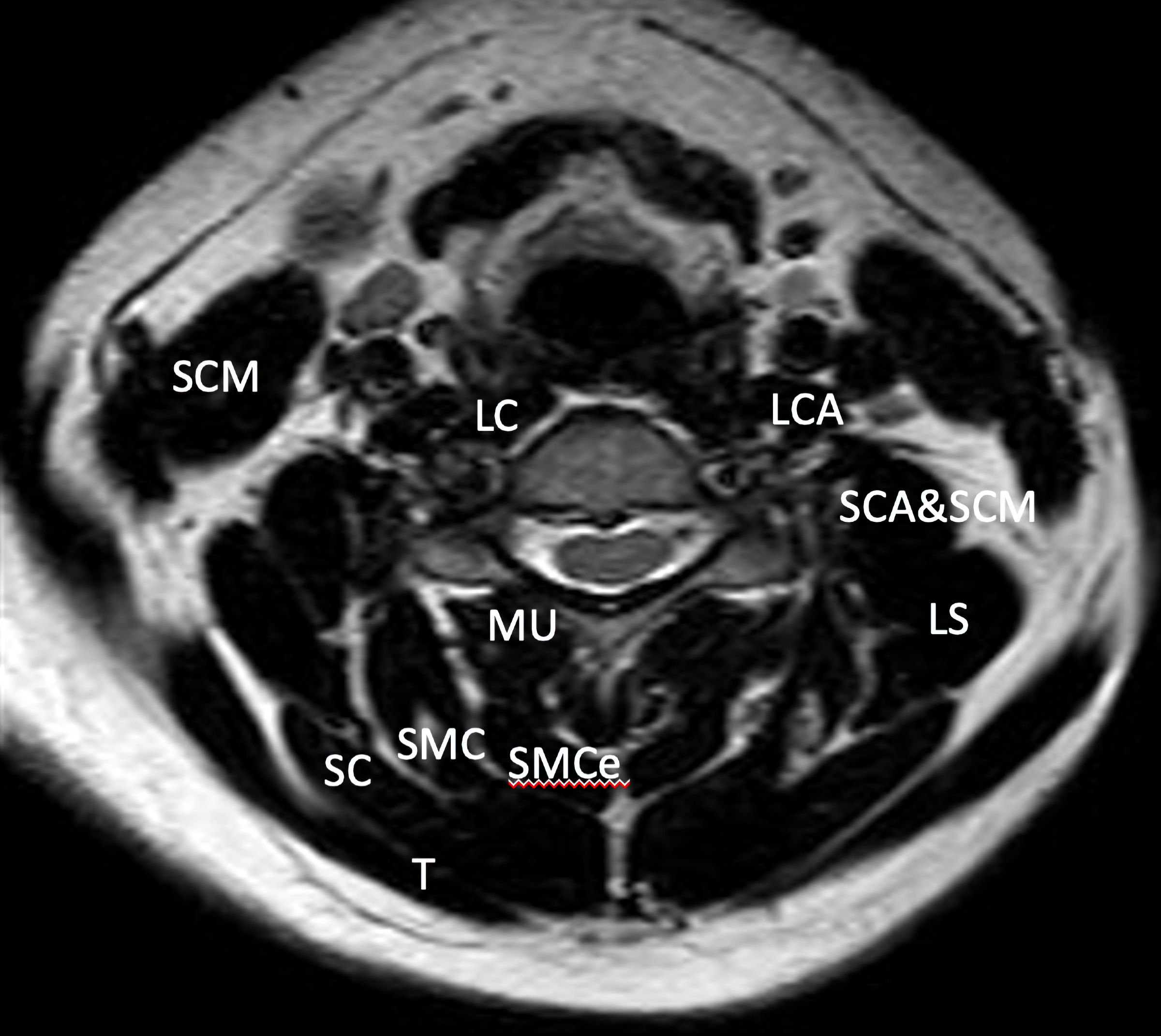 Mri Read Cervical Spine Axial View Anatomy Of Cervica 4470