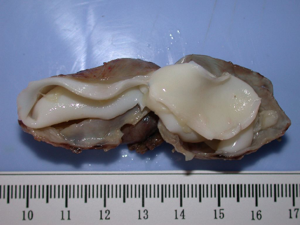 A. Cystic content was haematic. B: Hydatid membranes have the color red