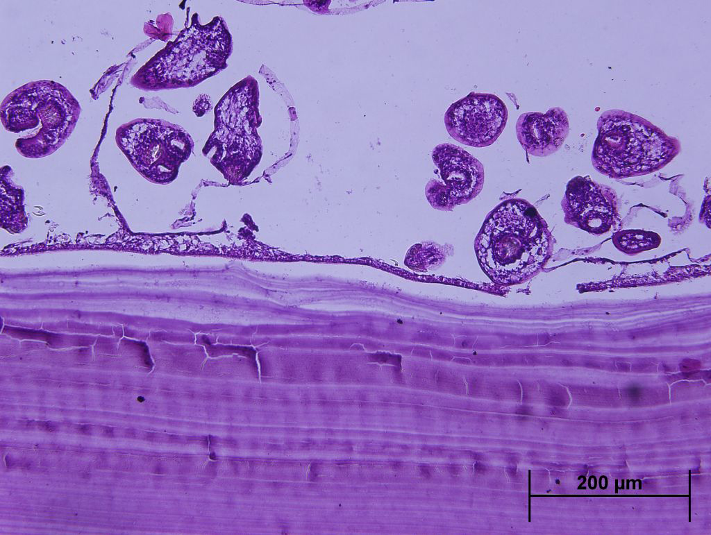 A. Cystic content was haematic. B: Hydatid membranes have the color red